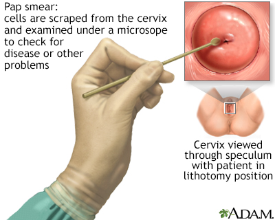 Pap smear - Illustration Thumbnail                      