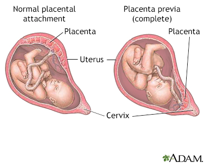 Placenta previa - Illustration Thumbnail                      