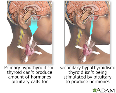 Primary and secondary hypothyroidism - Illustration Thumbnail                      