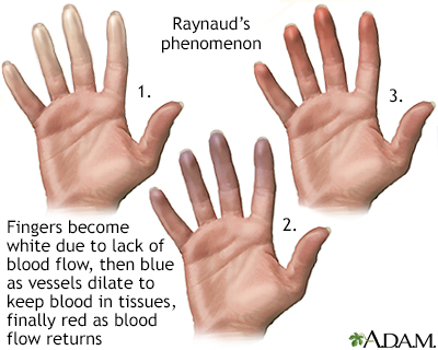 Raynaud's phenomenon - Illustration Thumbnail                      