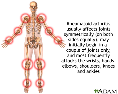 Rheumatoid arthritis - Illustration Thumbnail                      