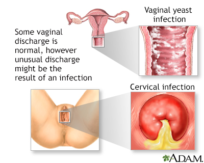 Vaginal discharge - Illustration Thumbnail                      