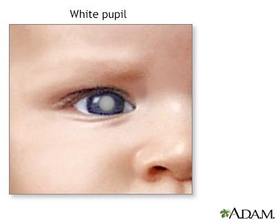 White spots in the pupil - Illustration Thumbnail                      