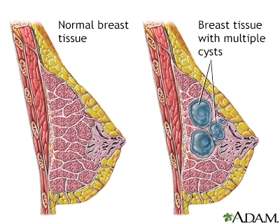 Fibrocystic breast disease - Illustration Thumbnail                      