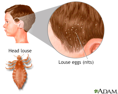 Head lice - Illustration Thumbnail                      