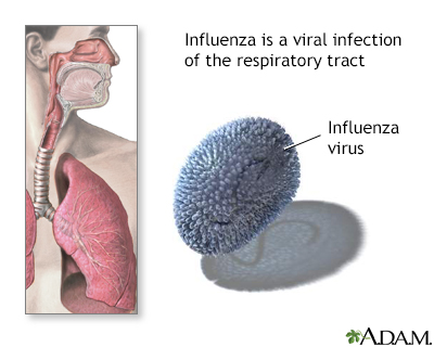 Influenza - Illustration Thumbnail                      