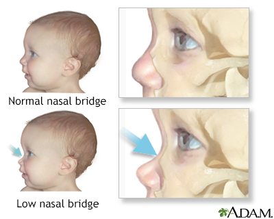 Low nasal bridge - Illustration Thumbnail                      