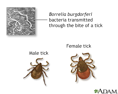 Tertiary Lyme disease - Illustration Thumbnail                      