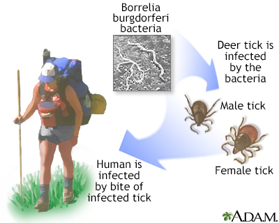 Lyme disease - Illustration Thumbnail                      