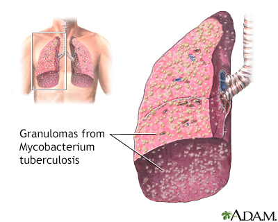 Miliary tuberculosis - Illustration Thumbnail                      
