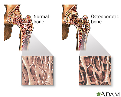 Osteoporosis - Illustration Thumbnail                      
