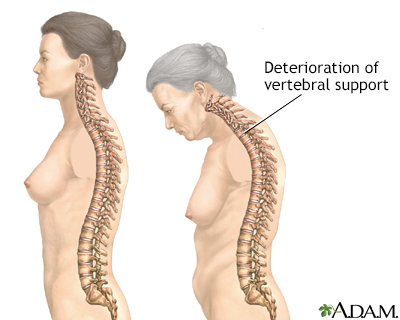 Osteoporosis - Illustration Thumbnail                      