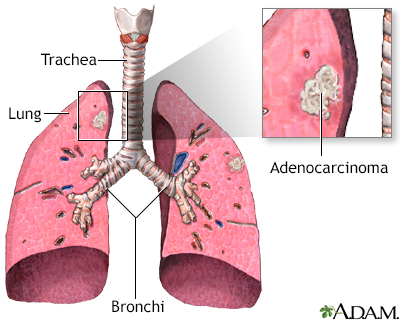 Adenocarcinoma - Illustration Thumbnail                      