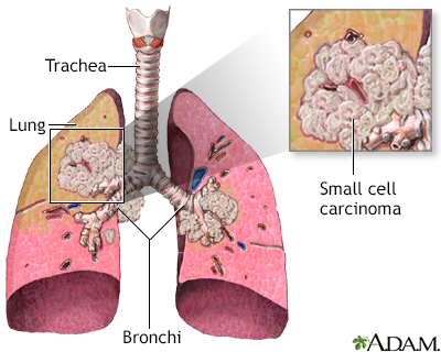Small cell carcinoma - Illustration Thumbnail                      