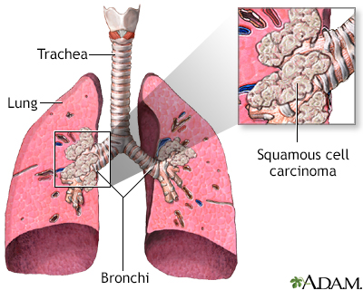 Squamous cell carcinoma - Illustration Thumbnail                      