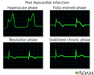 Post myocardial infarction ECG wave tracings - Illustration Thumbnail                      