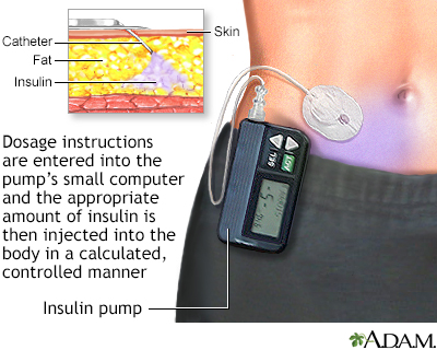 Insulin pump - Illustration Thumbnail                      