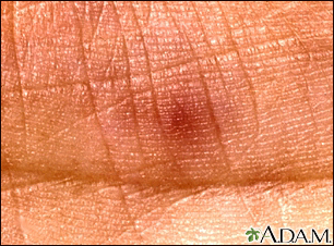 Janeway lesion - close-up - Illustration Thumbnail                      