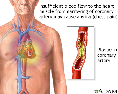 Stable angina - Illustration Thumbnail                      