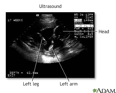 Ultrasound, normal fetus - ventricles of brain - Illustration Thumbnail                      