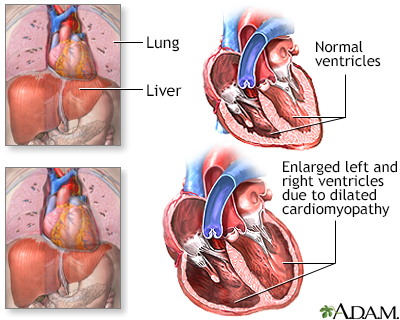 Alcoholic cardiomyopathy - Illustration Thumbnail                      