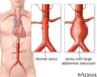 Aortic aneurysm - Illustration Thumbnail                      