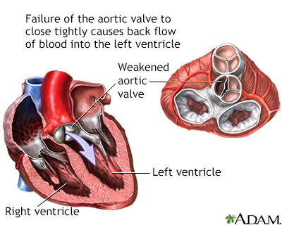 Aortic insufficiency - Illustration Thumbnail                      