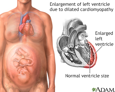 Peripartum cardiomyopathy - Illustration Thumbnail                      