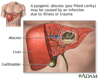 Pyogenic abscess - Illustration Thumbnail                      