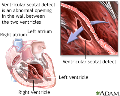 Ventricular septal defect - Illustration Thumbnail                      