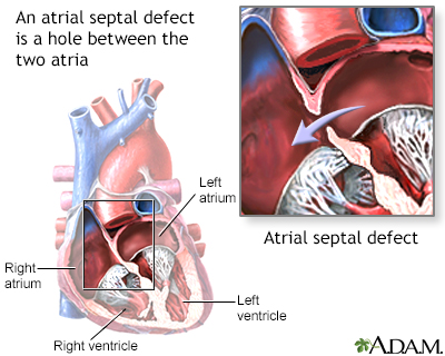 Atrial septal defect - Illustration Thumbnail                      