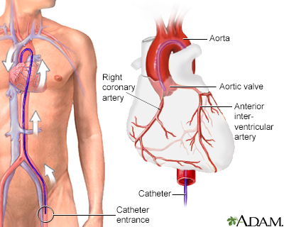 Coronary angiography - Illustration Thumbnail                      