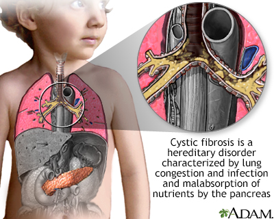 Cystic fibrosis - Illustration Thumbnail                      