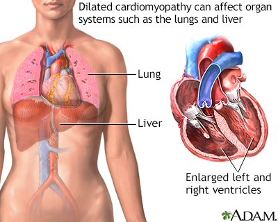 Dilated cardiomyopathy - Illustration Thumbnail                      