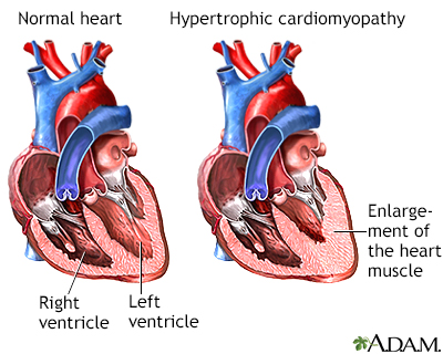 Hypertrophic cardiomyopathy - Illustration Thumbnail                      