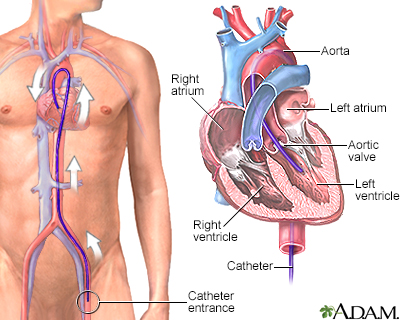 Left heart catheterization - Illustration Thumbnail                      