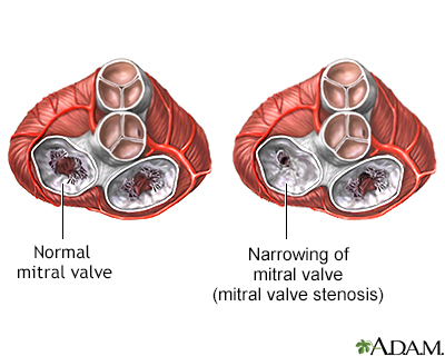 Mitral stenosis - Illustration Thumbnail                      