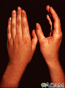 Erythema multiforme, circular lesions - hands - Illustration Thumbnail                      