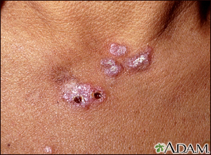 Lupus, discoid  - view of lesions on the chest - Illustration Thumbnail                      