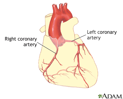 Coronary artery balloon angioplasty - Series - Presentation Thumbnail                    