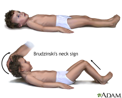 Brudzinski's sign of meningitis - Illustration Thumbnail                      