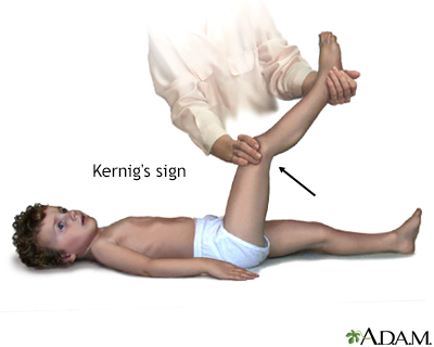 Kernig's sign of meningitis - Illustration Thumbnail                      