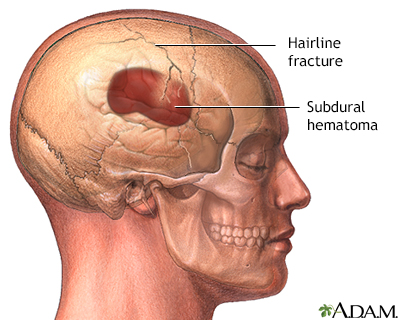 Skull fracture - Illustration Thumbnail                      