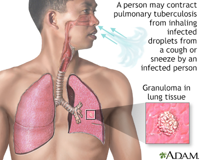 Tuberculosis of the lungs - Illustration Thumbnail                      