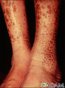 Ichthyosis, acquired - legs - Illustration Thumbnail                      