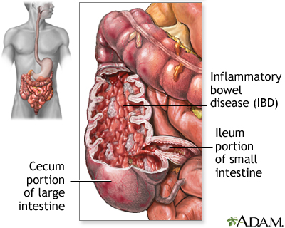 Inflammatory bowel disease - Illustration Thumbnail                      