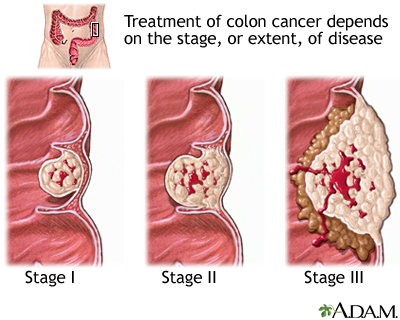 Stages of cancer - Illustration Thumbnail                      