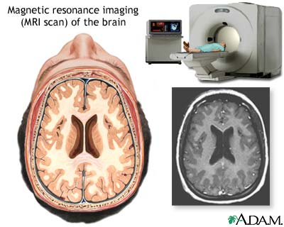 MRI of the brain - Illustration Thumbnail                      