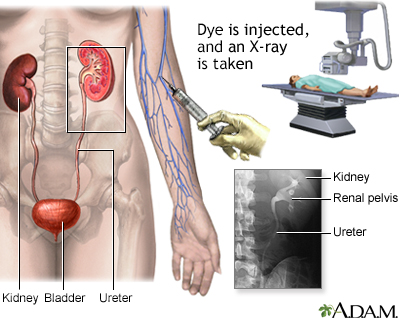 Intravenous pyelogram (IVP) - Illustration Thumbnail                      