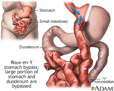 Roux-en-Y stomach surgery for weight loss - Illustration Thumbnail                      
